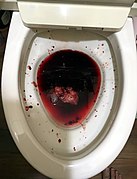 Bloody stool-1.jpg