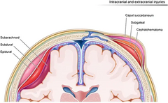 kefalogematoma