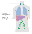 Stage 3 Hodgkin lymphoma