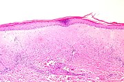 Histologie eines atrophen Lichen sclerosus.