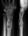 X-ray showing enchondromas localized in the lower part of the radius of a 37-year-old patient affected with Ollier disease