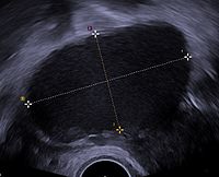 Endometrioma