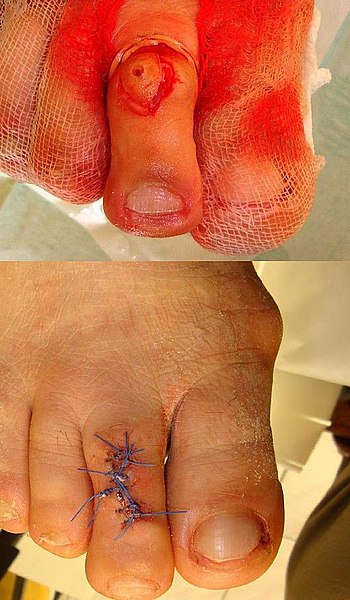 File:Plantar warts removal.jpg