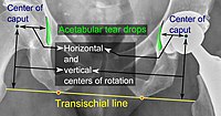 Center of rotation of a hip prosthesis