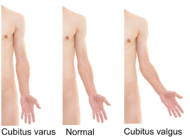 Cubitus varus and cubitus valgus