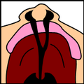 Fisura palatina y llabial completa billateral