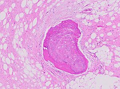 Bone formation may be seen in both lipomas[26] and liposarcomas (a well-differentiated one pictured).