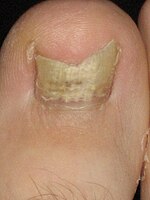 Onychomycosis