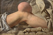 Photographie en couleurs d'une peinture représentant une partie de jambe droite avec une grosse tumeur dans la région patellaire.