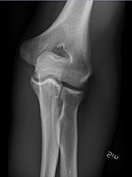 Normal elbow, anteroposterior projection