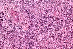 Wegener's granulomatosis -b- intermed mag.jpg