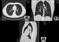 High-resolution computed tomographs of a normal thorax, taken in the axial, coronal and sagittal planes, respectively. Click here to scroll through the image stacks.