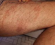 Erythema migrans, 8 weeks after presentation