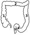 1: colon ascendent 2: colon transvers 3: colon descendent 4: colonul sigmoid 5: Rectum