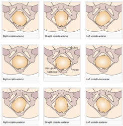 Cephalic presentations