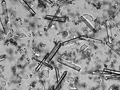 Cristaux de struvite dans une urine humaine de pH 9. On observe aussi de nombreux cristaux xénomorphes, plusieurs cellules épithéliales (squameuses et non squameuses) et quelques leucocytes.