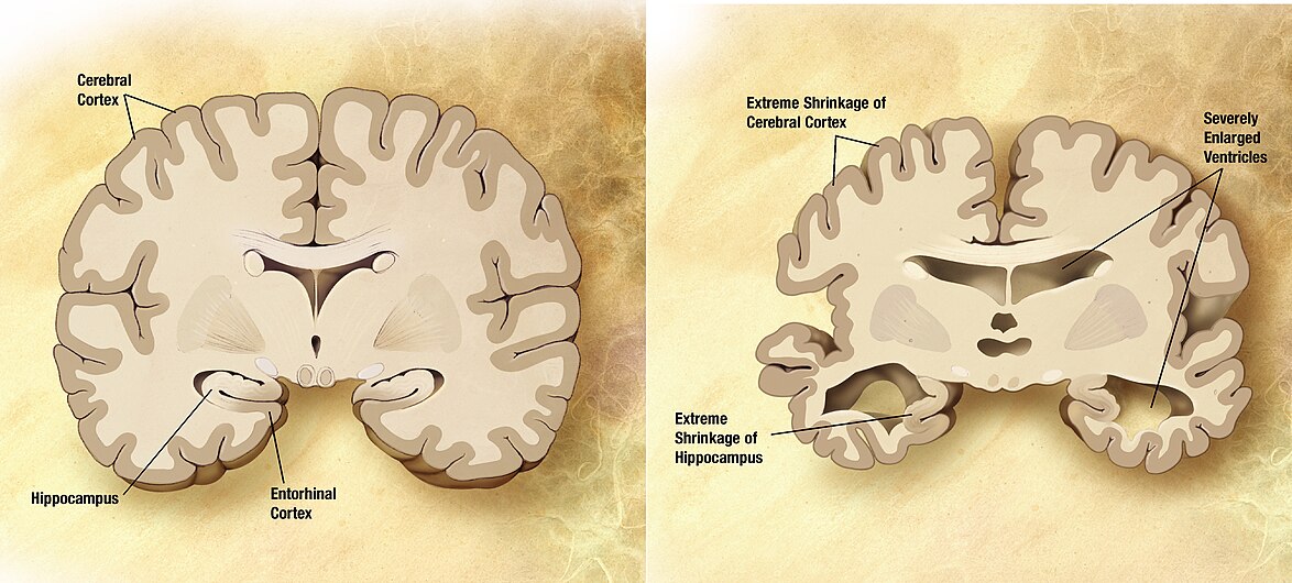 Alzheimer's disease brain comparison.jpg