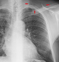 Supraclavicular fossa