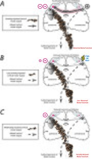 Thumbnail for File:Rebalance inter-hemispheric inhibition model.jpg