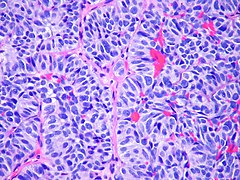 Atypical carcinoid tumor of lung metastatic to the adrenal gland Case 255 (8268010336).jpg