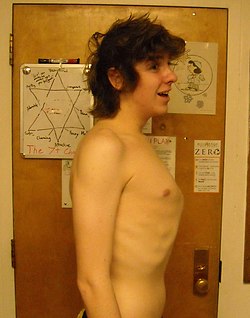 Ben Fraser pectus carinatum.jpg