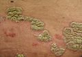 Plaques de psoriasis