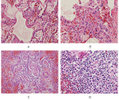 Human Disease from Influenza A (H5N1), Thailand, 2004