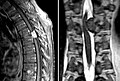 Meningeom im Spinalkanal Kernspintomographie. Links T1 sagittal mit Kontrastmittel, rechts T2 coronar