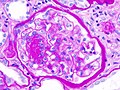 Vorschaubild für Diabetische Nephropathie