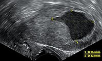 Postmenopausal endometrial fluid