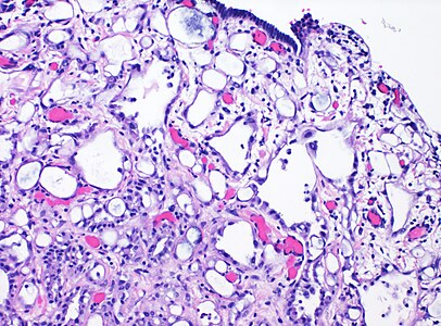 High magnification of the same case, showing the typical[9] features of tubular spaces of varying size composed of flattened cells resembling endothelium.