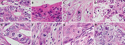 Normal and atypical forms of mitosis in cancer cells. A, normal mitosis; B, chromatin bridge; C, multipolar mitosis; D, ring mitosis; E, dispersed mitosis; F, asymmetrical mitosis; G, lag-type mitosis; and H, micronuclei. H&E stain.