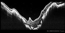 Coupe OCT d'une patiente présentant le syndrome de la fleur de Liseron