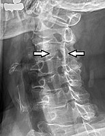 Stenosis of intervertebral foramen