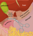 * Nomination: Pringle manoeuvre, surgical procedure --Orem 15:32, 15 August 2013 (UTC) * * Review needed