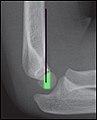 Anterior humeral line Attribution-Share Alike 4.0 International license, attributed to Tracy Kilborn, Halvani Moodley, Stewart Mears and Mikael Häggström