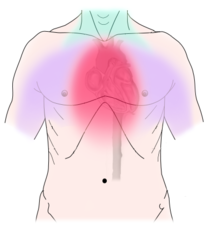 Angina pectoris.png