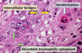 Squamous cell carcinoma with typical histopathology features.