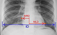 Cardiothoracic ratio