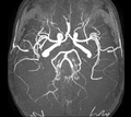 Poligono di Willis, immagine di risonanza magnetica, sequenze angiografiche, veduta dall'alto