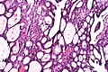 Papillary urothelial carcinoma with cribriform morphology, high mag