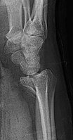 Barton's fracture