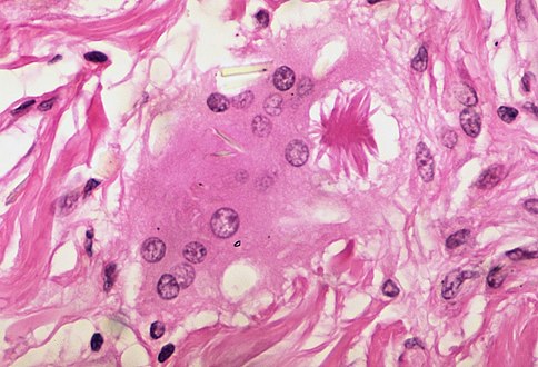 Asteroid body in sarcoidosis