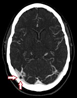 Arachnoid granulation