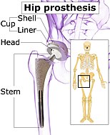 Hip prosthesis components Attribution-Share Alike 4.0 International license, attributed to BruceBlaus and Mikael Häggström