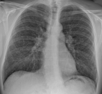 Sarcoidosis nodules