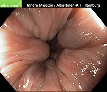 Haemorrhoiden 2Grad endo 02.jpg