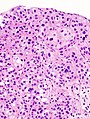 Histopathology of urothelial carcinoma of the urinary bladder, showing a nested pattern of invasion. Transurethral biopsy. H&E stain