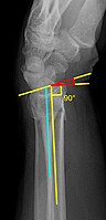 Dorsal tilt of distal radius fracture