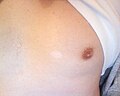 Nevus depigmentosus